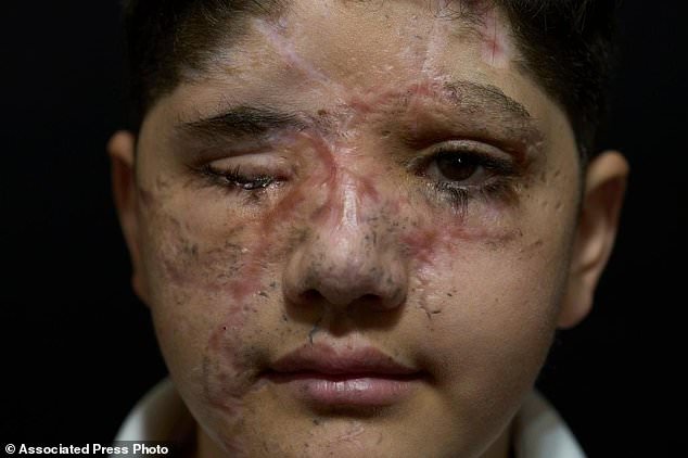 Ali Abbas, 11, who was wounded in the pager attacks carried out by Israel on Sept. 17, 2024, poses for a photograph in the southern village of Barish, Lebanon, April 28, 2025. (AP Photo/Hassan Ammar, File)